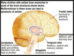 Brain Structure Autism